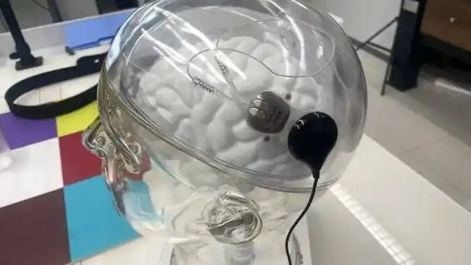 从解码大脑到调控大脑，为脑疾病治疗开启新可能