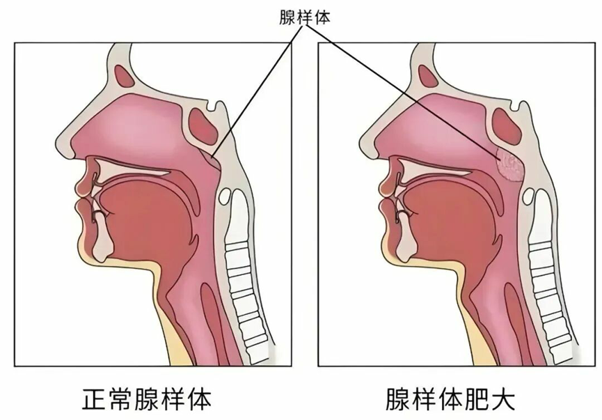 孩子反应慢，睡着后经常打鼾？要警惕这个病